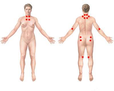 Fibromyalgia Trigger Points. Diagnosis of fibromyalgia